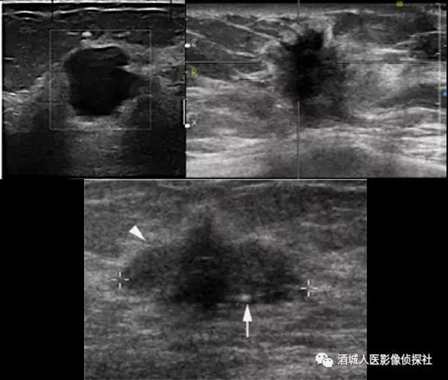 鉬靶、超聲、磁共振...篩查早期乳腺癌到底該選啥？(圖3)