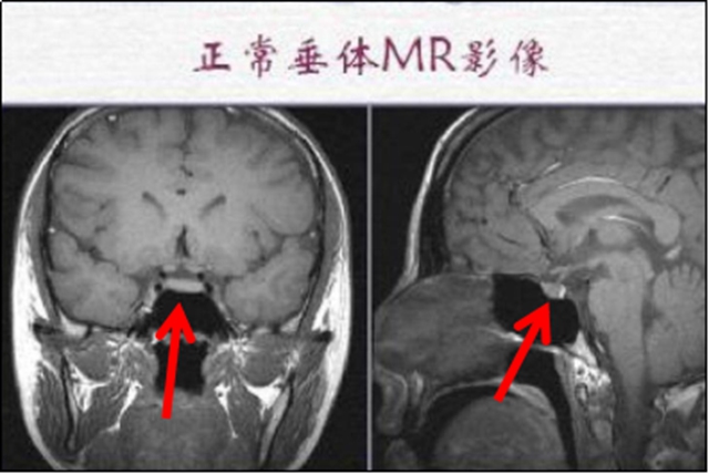 【擴(kuò)散】孩子長(zhǎng)太高？警惕腦子出問題！(圖3)