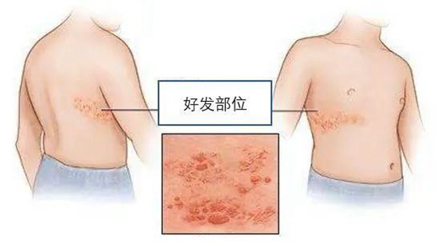 “蛇纏腰”可通過打疫苗預(yù)防，趕緊帶父母去打(圖3)