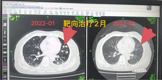 【科普】開啟肺癌腫瘤治療新時代——靶向和免疫治療(圖3)