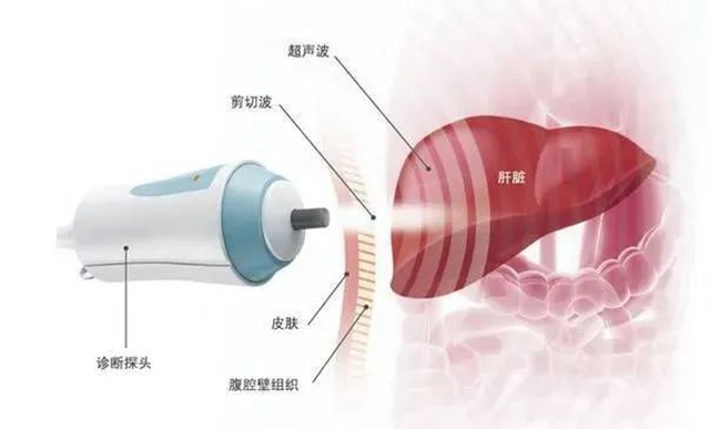 您的肝還好嗎？教您一分鐘看懂您的“肝彈性檢查報(bào)告”