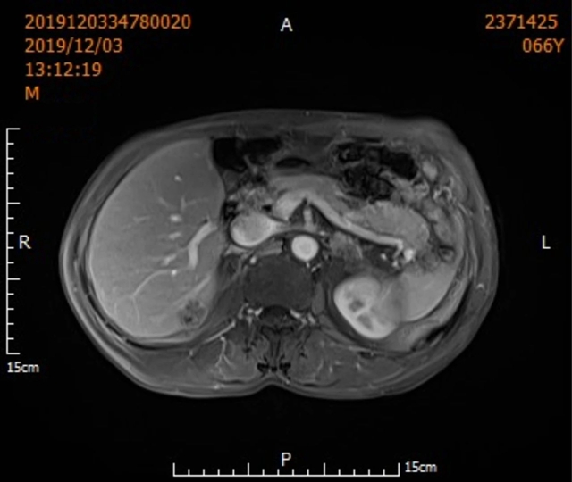 【圍觀】超低溫-160 ℃，凍死腫瘤，癌癥不用開刀了