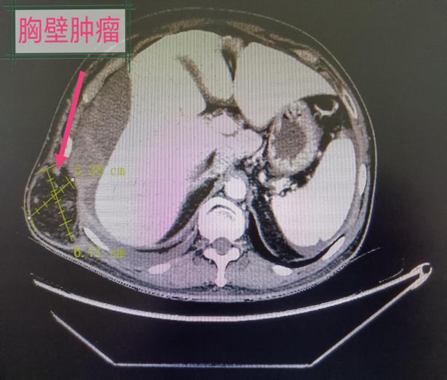 9個科室的專家集體出動，為他取出滿滿一盆腫瘤...