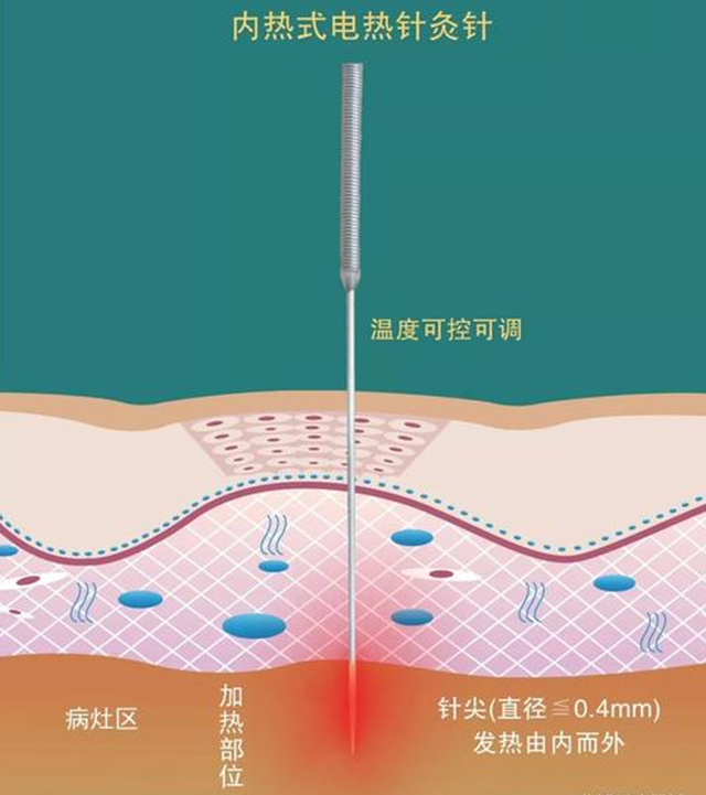 【新技術(shù)】中醫(yī)“手術(shù)刀”——內(nèi)熱針技術(shù)