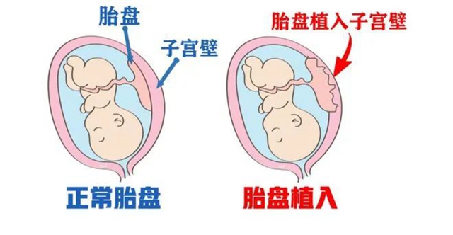 【兇險】罕見的熊貓血孕婦，出血“一灘”......