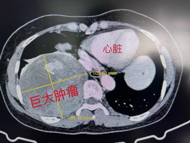 【圍觀】直徑超13厘米，女子長出巨大腫瘤！