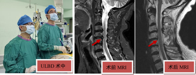 僅開直徑不足1厘米小孔做手術，就解決了75歲婆婆常年手臂疼痛困擾……