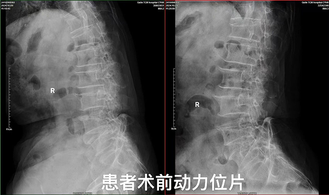 【專(zhuān)科技術(shù)】古藺縣中醫(yī)醫(yī)院椎間孔鏡髓核摘除術(shù)：精準(zhǔn)祛痛，脊柱微創(chuàng)新希望！