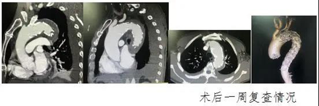 瀘州市人民醫(yī)院首次獨(dú)立成功完成復(fù)雜胸腹主動脈夾層血管腔內(nèi)修復(fù)術(shù)(圖3)