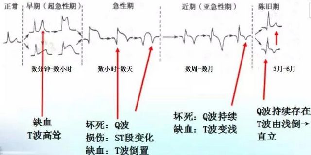 你的心臟在求救！急性心梗的這些預(yù)警信號， 你知道嗎？(圖9)