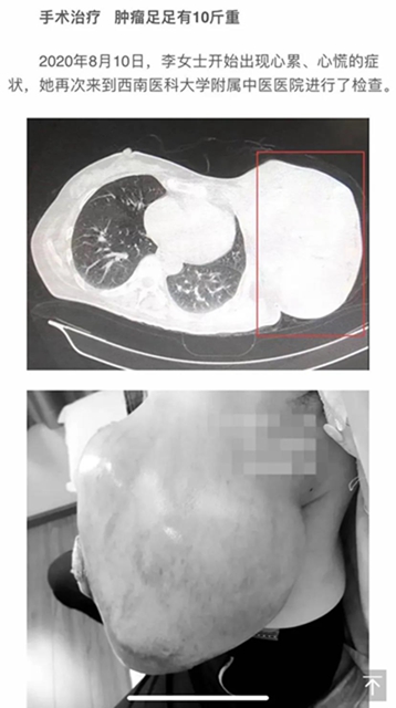 【圍觀】腫瘤這么大，一定是惡性了？