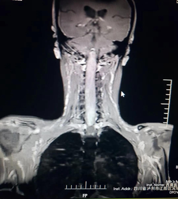 30厘米罕見腫瘤 ，10名醫(yī)療人員，連續(xù)11個(gè)小時(shí)的手術(shù)······(圖1)