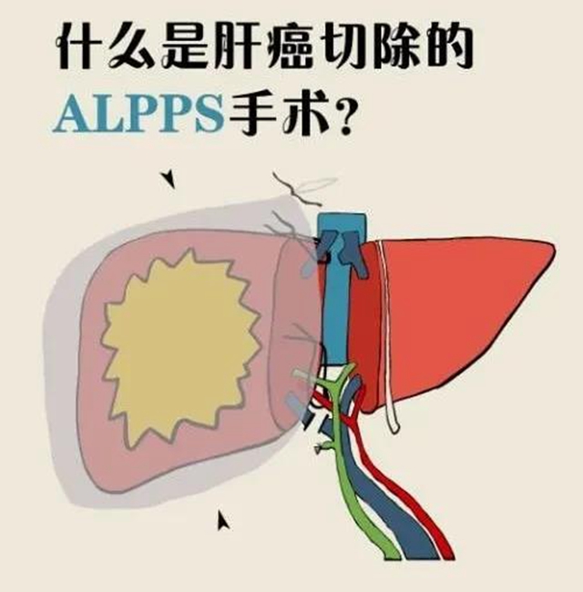 【擴散】肝癌中晚期患者，可以根治啦？(圖4)