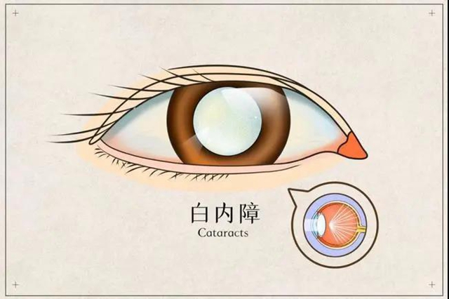 【提醒】躲不過(guò)的白內(nèi)障，究竟何時(shí)做才最有效？(圖1)