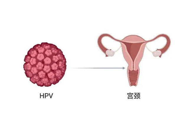 【擴(kuò)散】感染了HPV病毒，就是得了宮頸癌？(圖1)