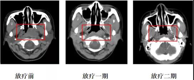 所有的腫瘤患者都需要放療嗎？(圖6)