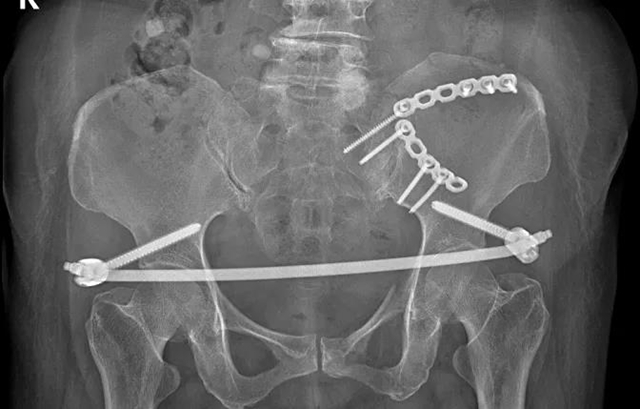 【技術】嬢嬢不慎骨盆骨折，INFIX微創(chuàng)手術解難題！(圖4)